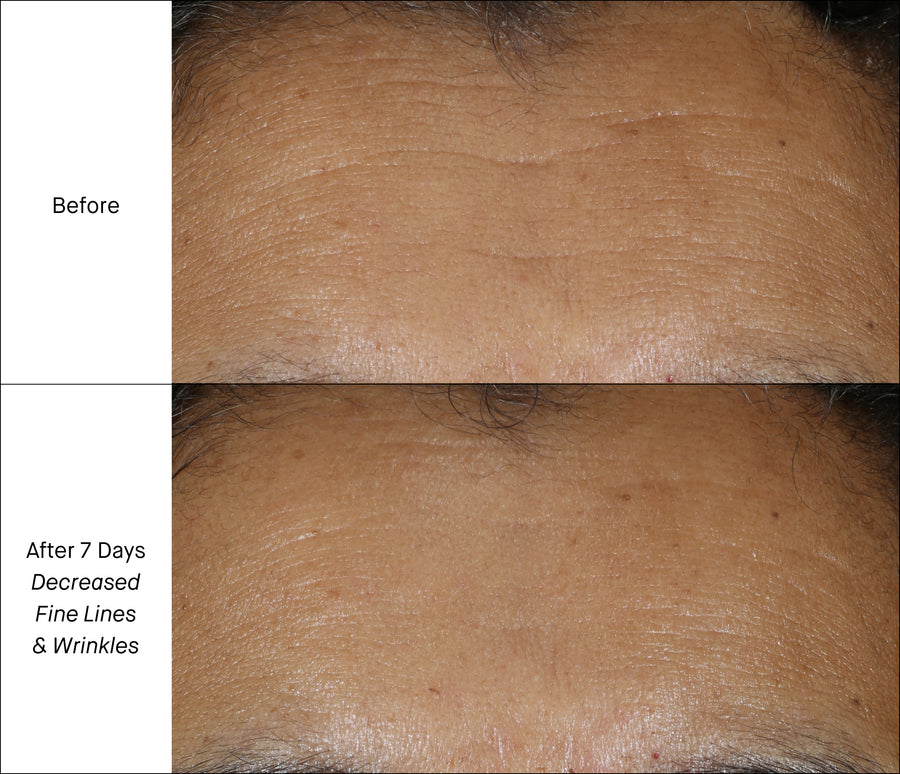 Forehead Fine Lines 7 Days Before & After Treatment
