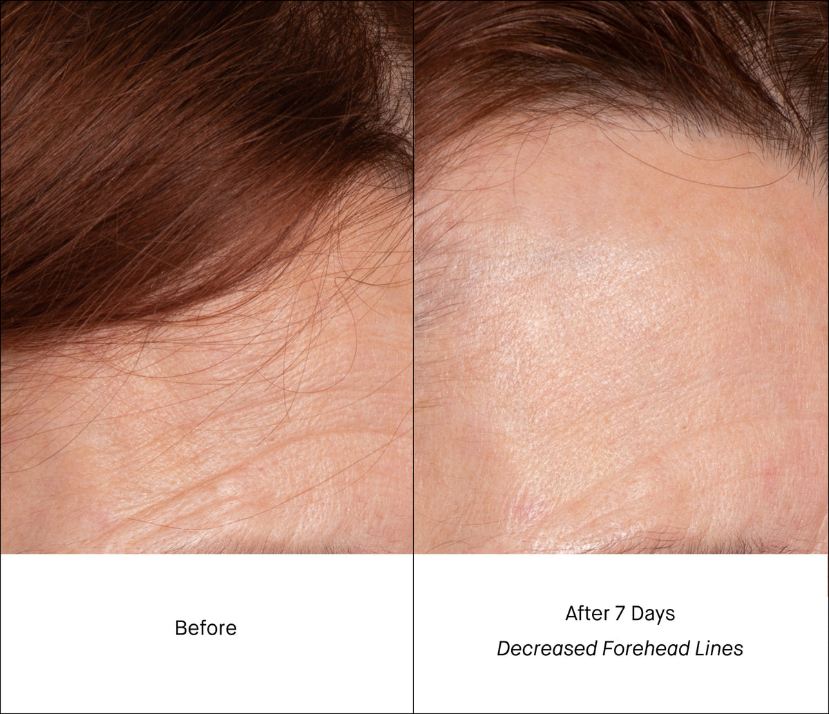 Forehead Lines Before & After 7 Days of Treatment