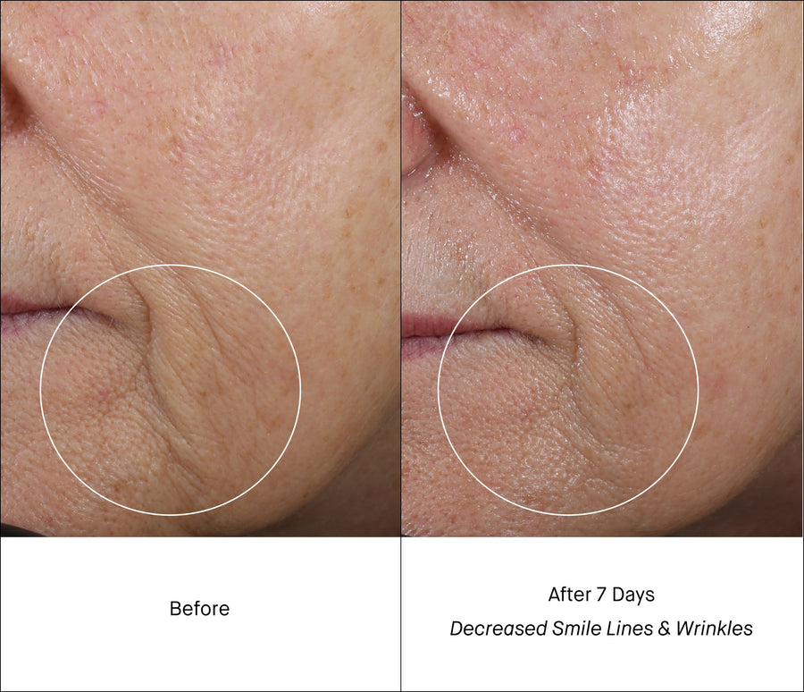 Smile Lines Before & After 7 Days of Treatment