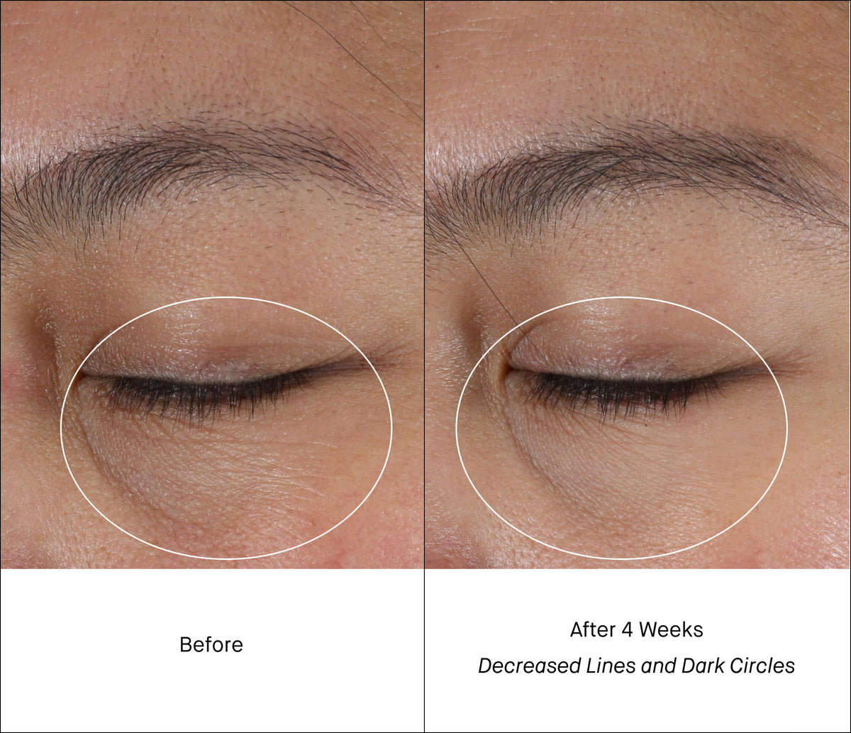 Dark Circles Before & After Intensive Eye Renewal Cream