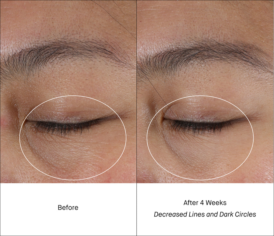 Dark Circles Before & After Intensive Eye Renewal Cream