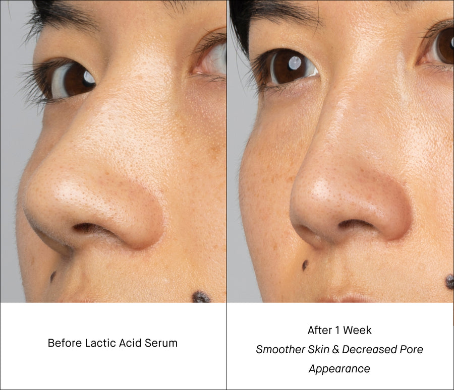 Lactic Acid Serum B&A - Pores on Nose