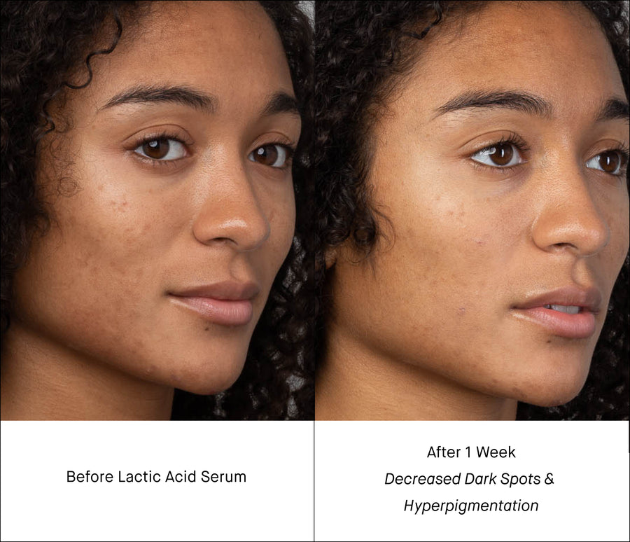 Lactic Acid Before & After - Hyperpigmentation