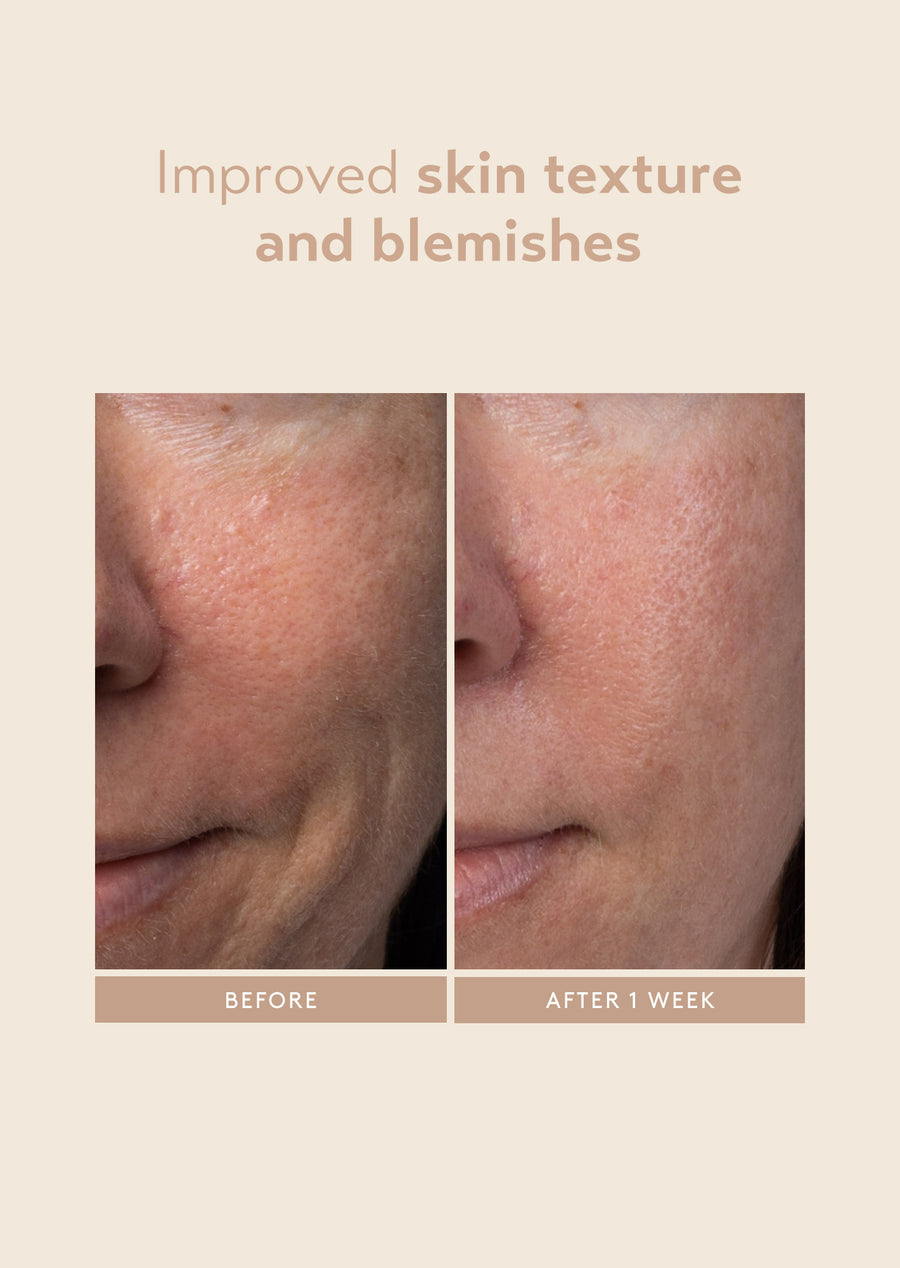 lactic acid serum