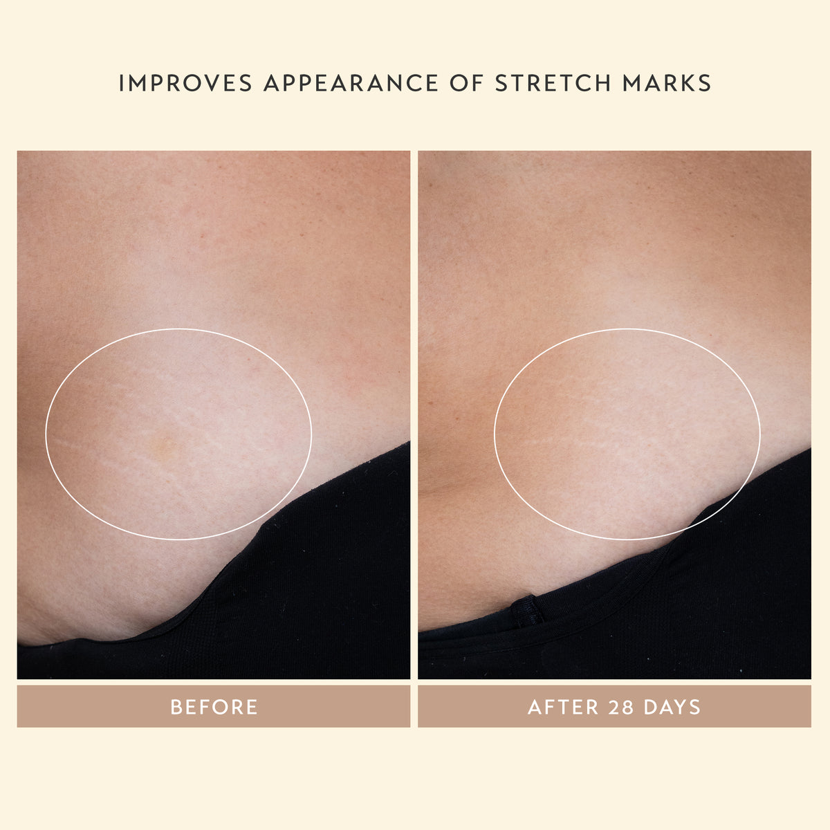 Improves Appearance Of Stretch Marks