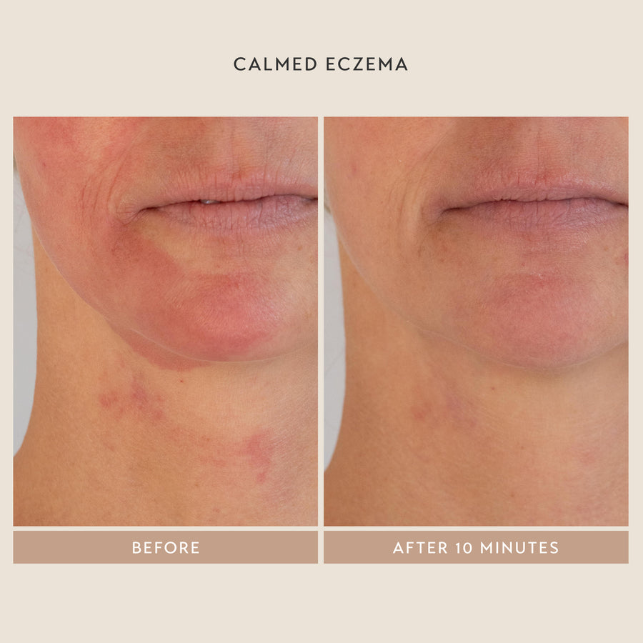 Calmed Eczema