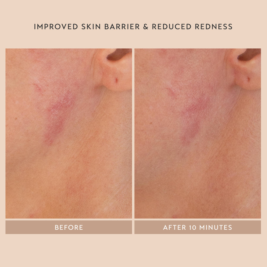 Improved Skin Barrier & Reduced Redness
