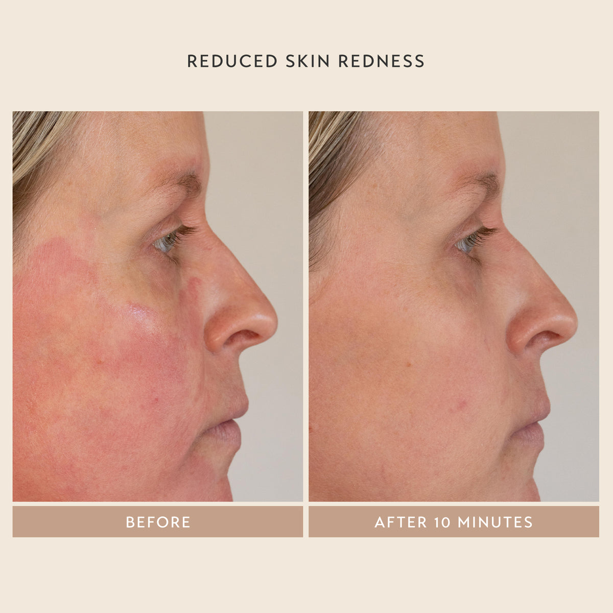 Reduce Skin Redness