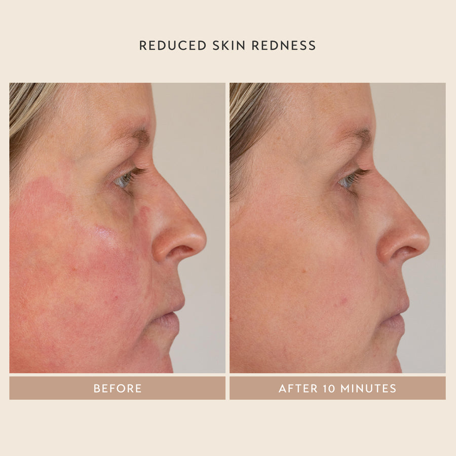 Reduce Skin Redness