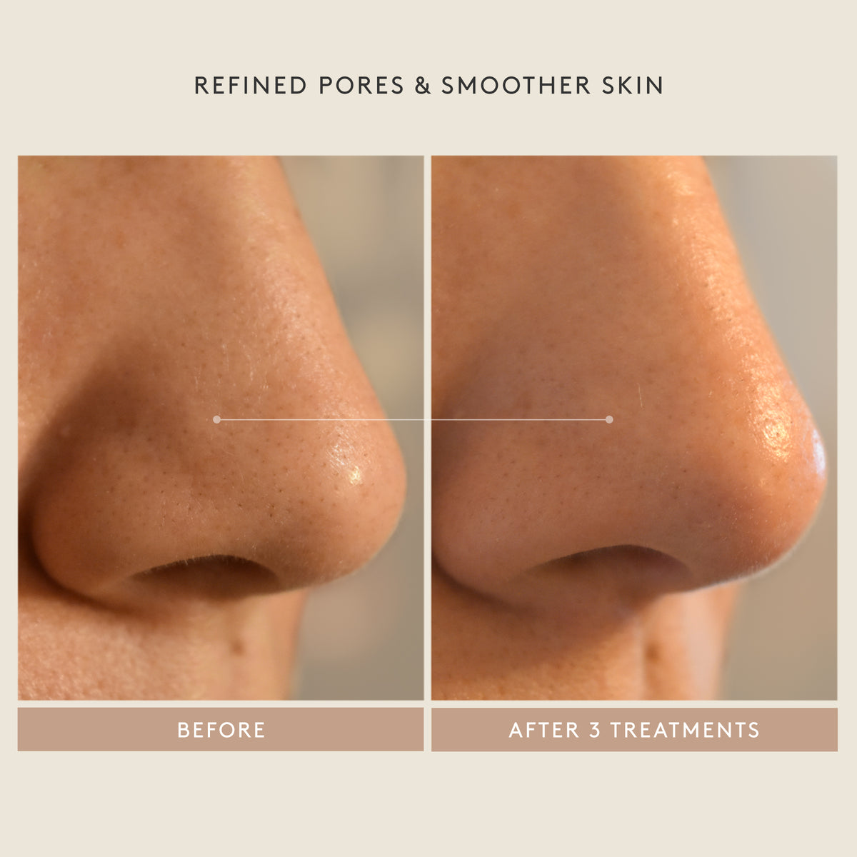 Triple Acid Peel Before & After