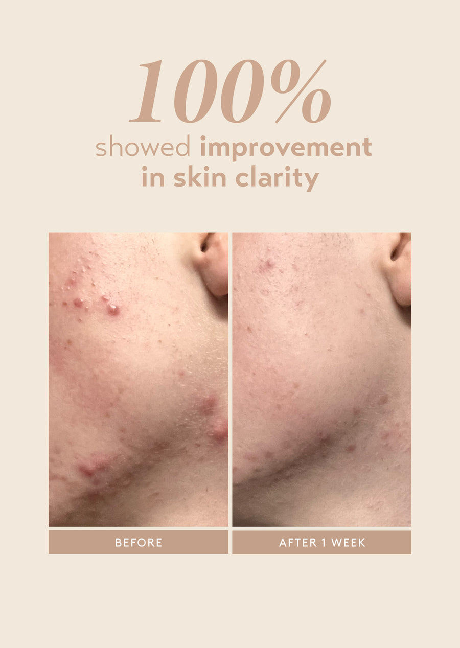 before and after 1 week using shani darden rescue serum with 10% azelaic acid, showing visible improvement in skin clarity and reduction in redness and blemishes.