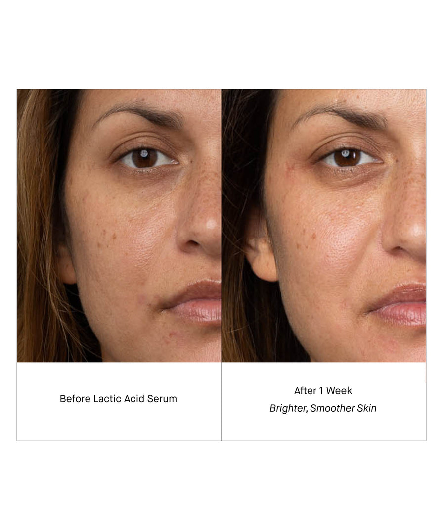 before & after lactic acid serum - brighter, smoother skin