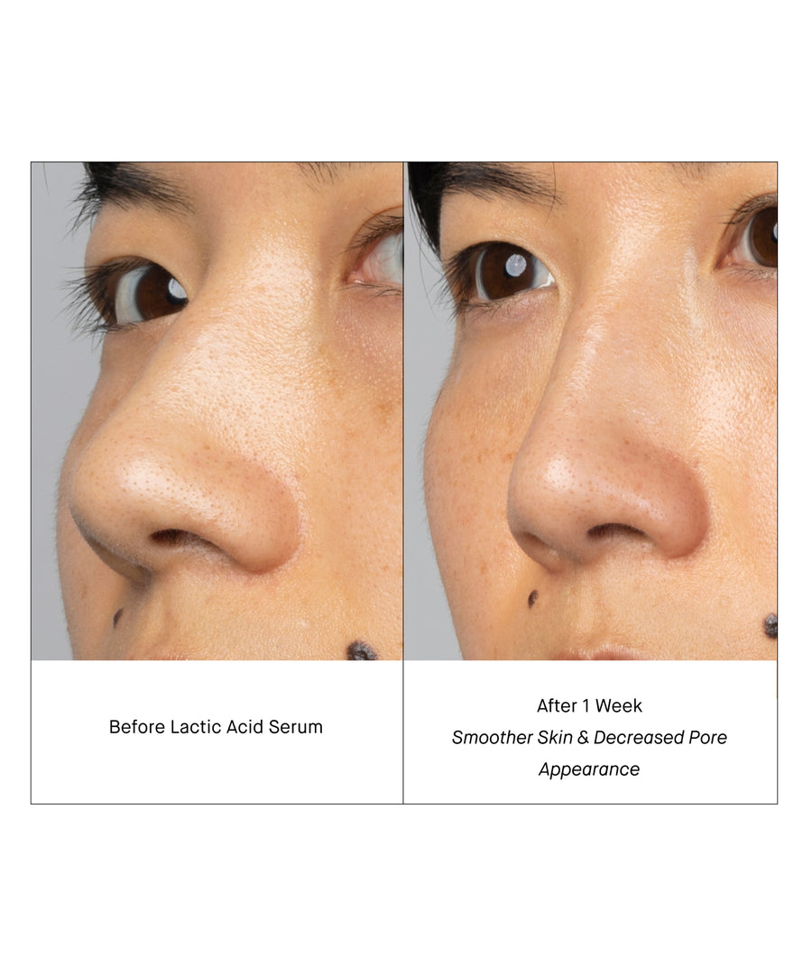 before & after lactic acid serum - smoother skin, decreased pore appearance