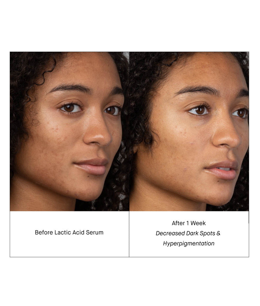 before & after lactic acid serum - decreased dark spots & hyperpigmentation