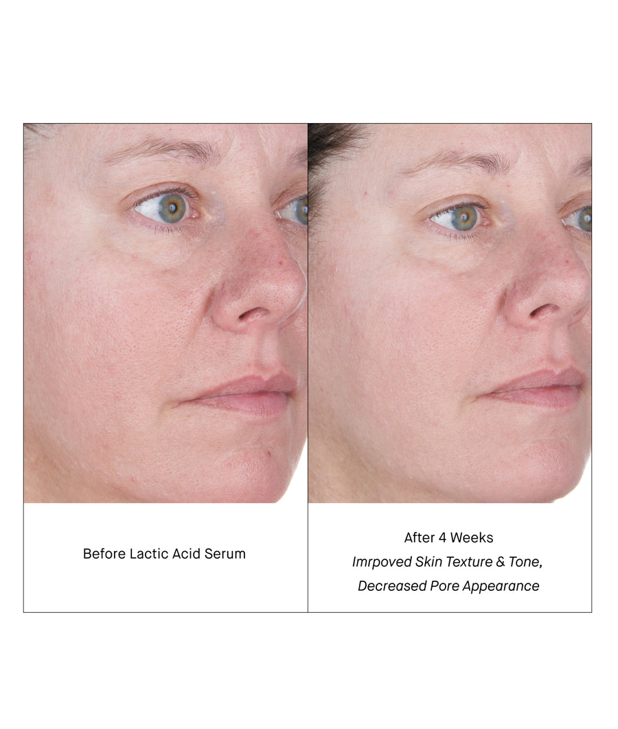 Lactic acid for face online